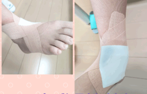 湿布とテーピング処置のイメージ
