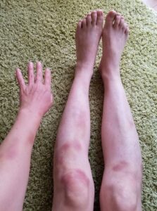 打撲による腫れと内出血の様子