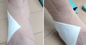 足首の捻挫に湿布とテーピング処置をした